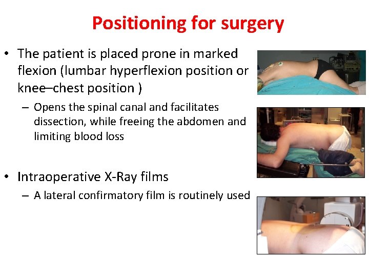 Positioning for surgery • The patient is placed prone in marked flexion (lumbar hyperflexion