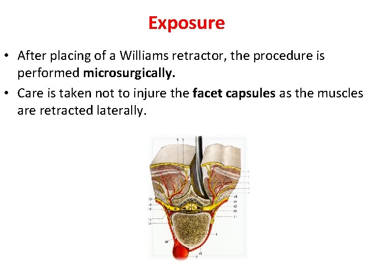 Exposure • After placing of a Williams retractor, the procedure is performed microsurgically. •