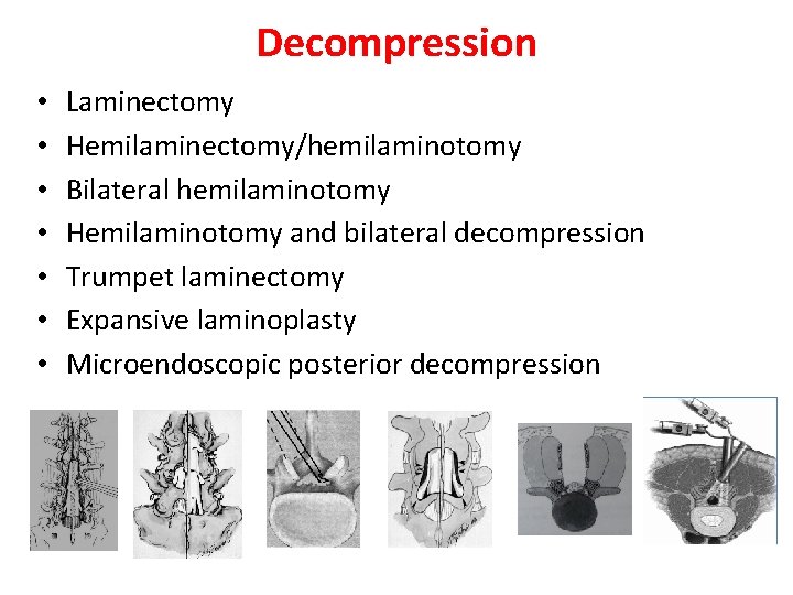Decompression • • Laminectomy Hemilaminectomy/hemilaminotomy Bilateral hemilaminotomy Hemilaminotomy and bilateral decompression Trumpet laminectomy Expansive