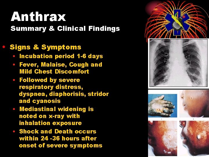 Anthrax Summary & Clinical Findings • Signs & Symptoms • Incubation period 1 -6