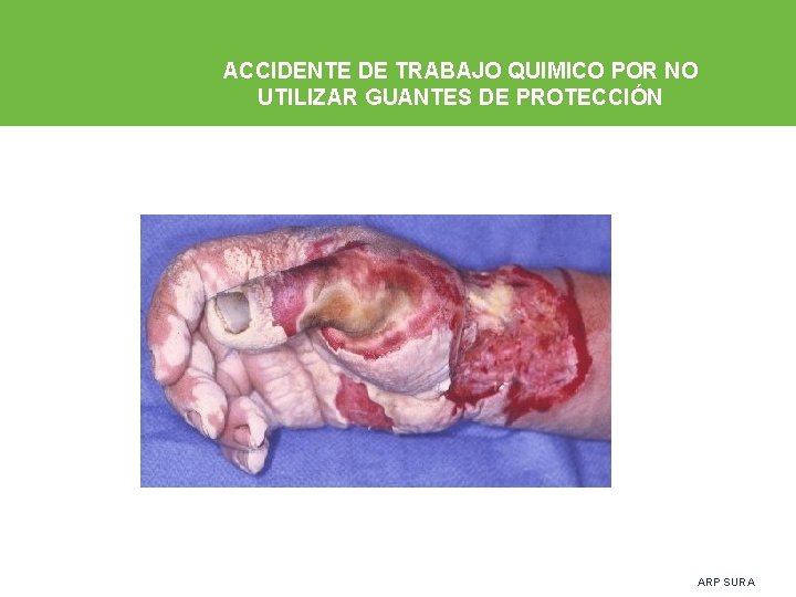 ACCIDENTE DE TRABAJO QUIMICO POR NO UTILIZAR GUANTES DE PROTECCIÓN ARP SURA 