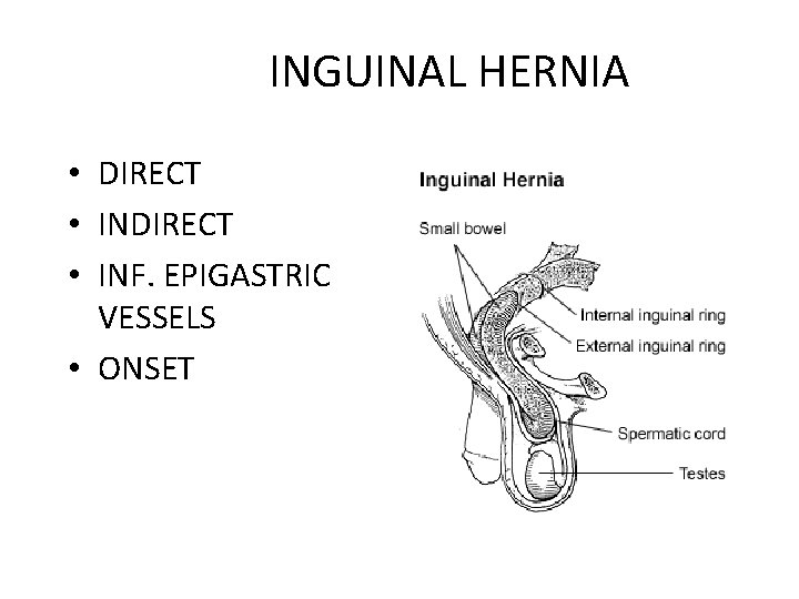 INGUINAL HERNIA • DIRECT • INF. EPIGASTRIC VESSELS • ONSET 