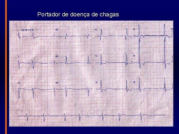 Portador de doença de chagas 