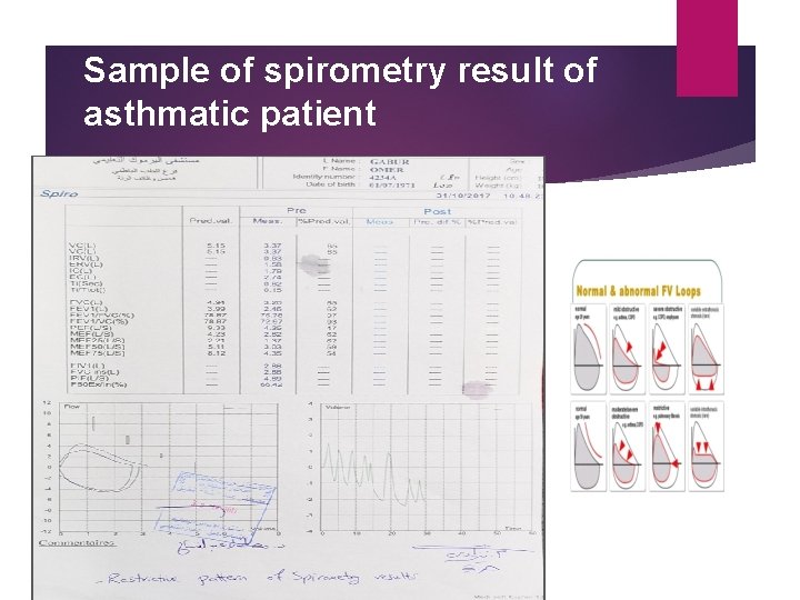 Sample of spirometry result of asthmatic patient 