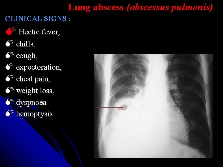 Lung abscess (abscessus pulmonis) CLINICAL SIGNS : Hectic fever, chills, cough, expectoration, chest pain, Lung abscess (abscessus pulmonis) CLINICAL SIGNS : Hectic fever, chills, cough, expectoration, chest pain,