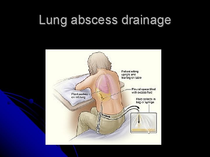 Lung abscess drainage Lung abscess drainage