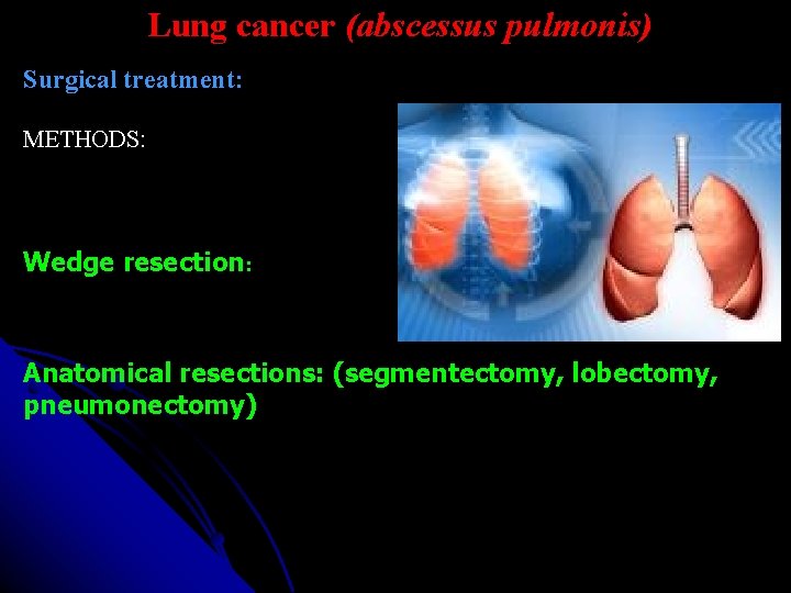 Lung cancer (abscessus pulmonis) Surgical treatment: METHODS: Wedge resection: Anatomical resections: (segmentectomy, lobectomy, pneumonectomy)