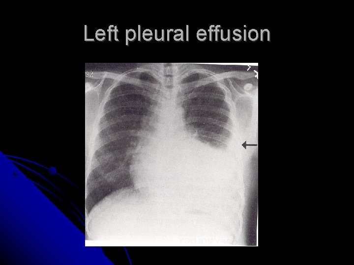 Left pleural effusion 