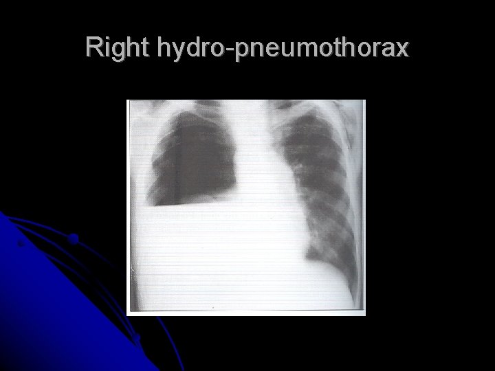 Right hydro-pneumothorax 