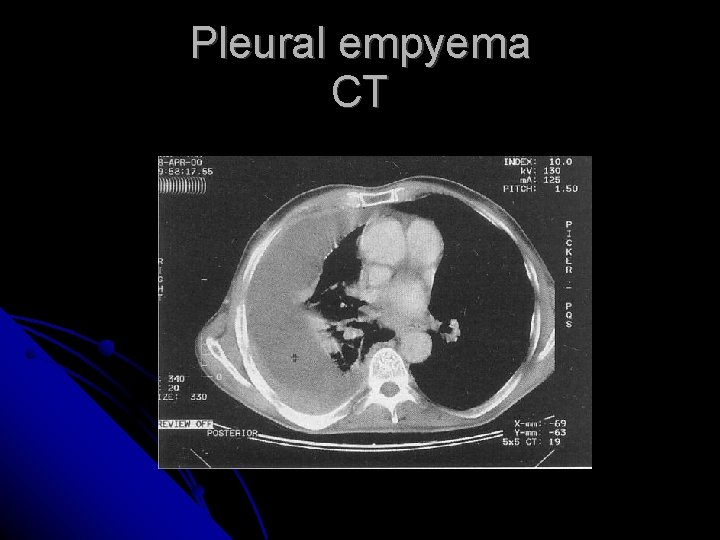 Pleural empyema CT Pleural empyema CT