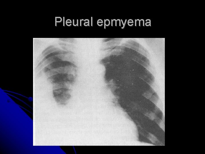 Pleural epmyema Pleural epmyema