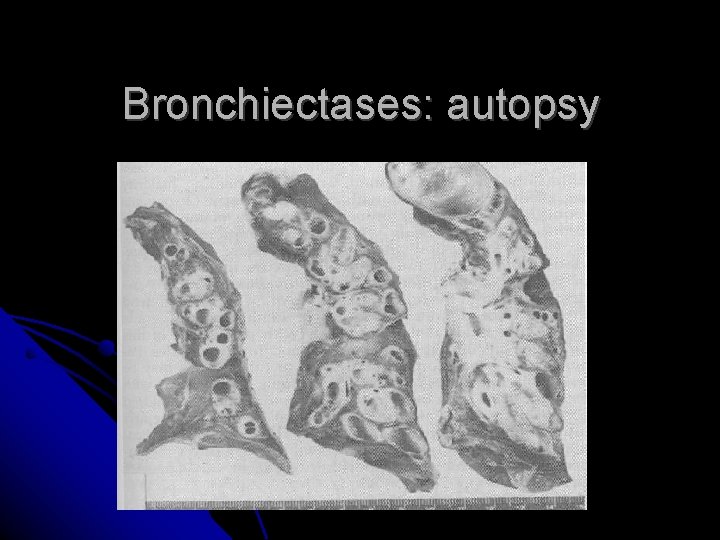 Bronchiectases: autopsy Bronchiectases: autopsy
