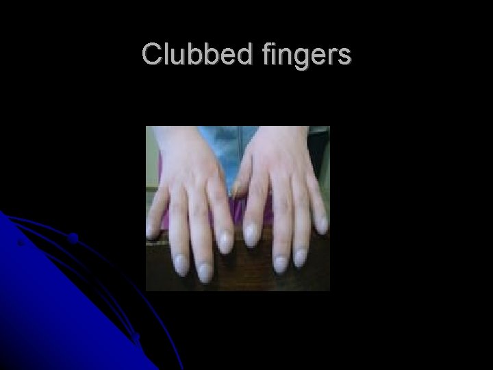 Clubbed fingers 