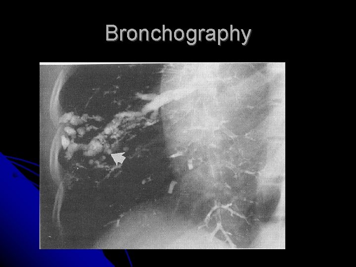 Bronchography 