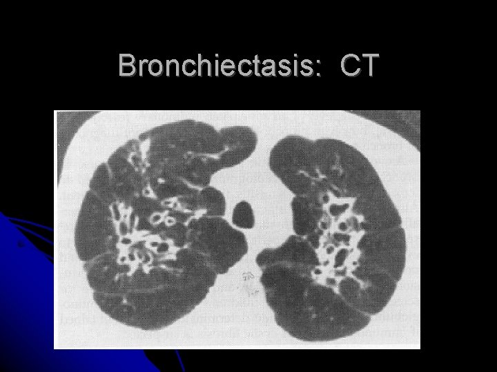 Bronchiectasis: CT Bronchiectasis: CT