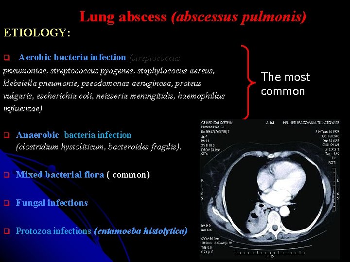 Lung abscess (abscessus pulmonis) ETIOLOGY: Aerobic bacteria infection (streptococcus pneumoniae, streptococcus pyogenes, staphylococus aereus,
