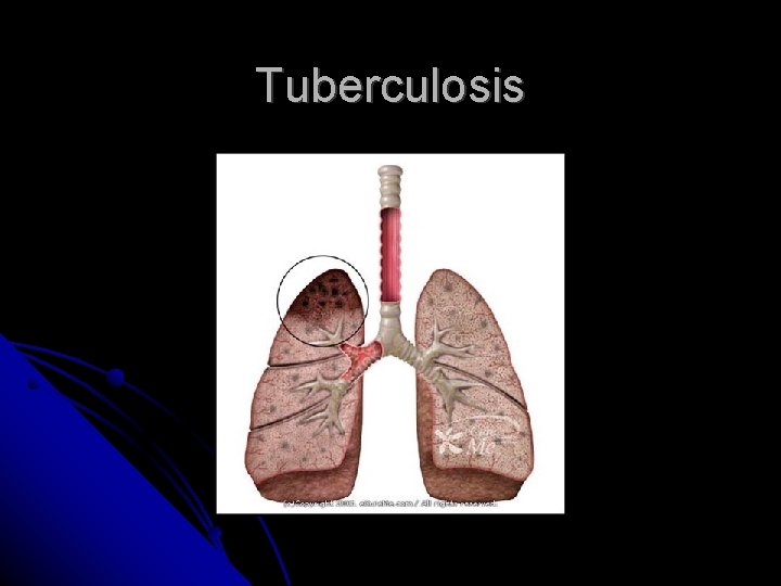 Tuberculosis Tuberculosis