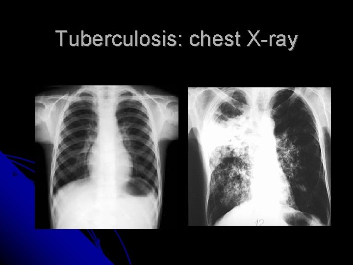 Tuberculosis: chest X-ray 