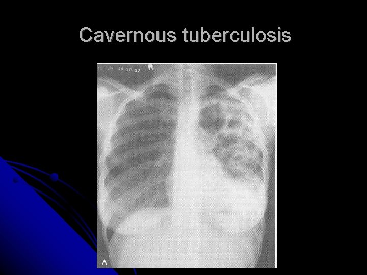 Cavernous tuberculosis 