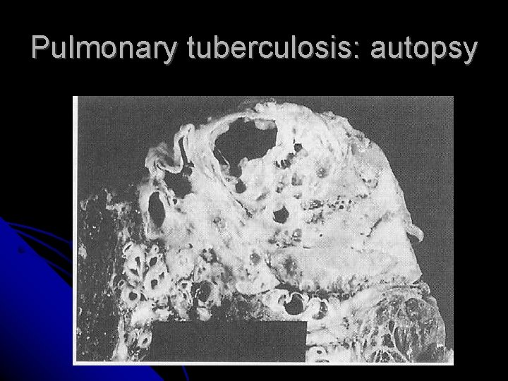 Pulmonary tuberculosis: autopsy 