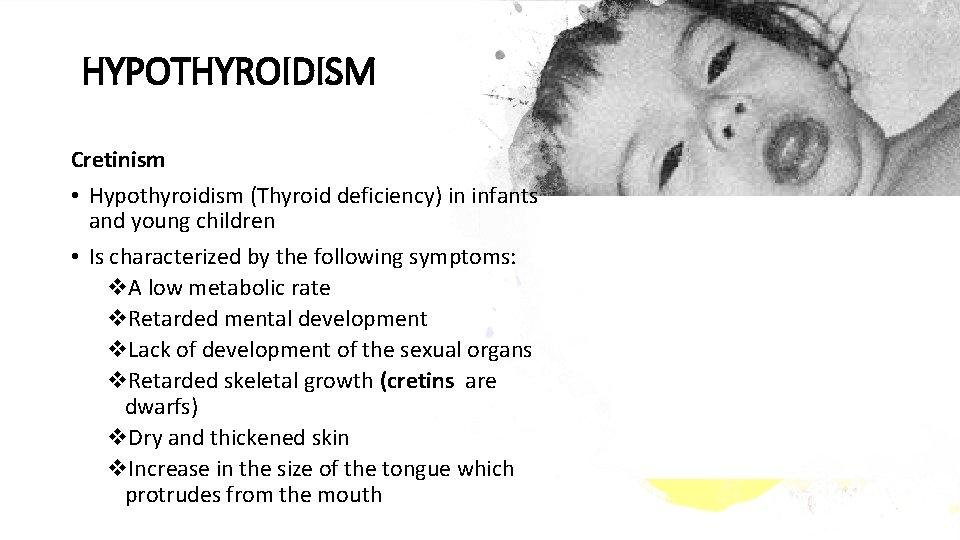 HYPOTHYROIDISM Cretinism • Hypothyroidism (Thyroid deficiency) in infants and young children • Is characterized