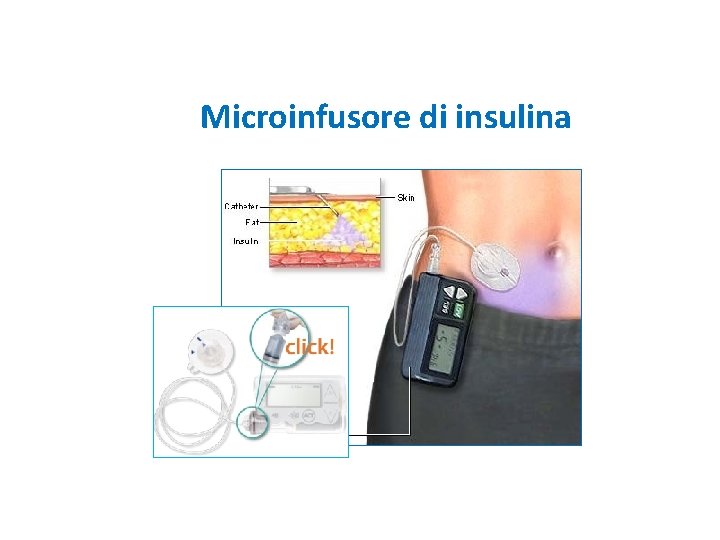 Microinfusore di insulina 