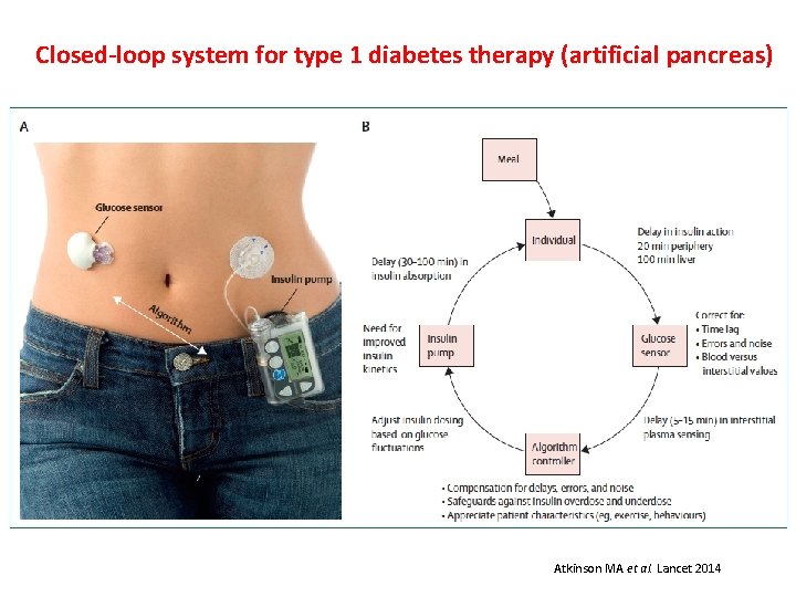 Closed-loop system for type 1 diabetes therapy (artificial pancreas) Atkinson MA et al. Lancet