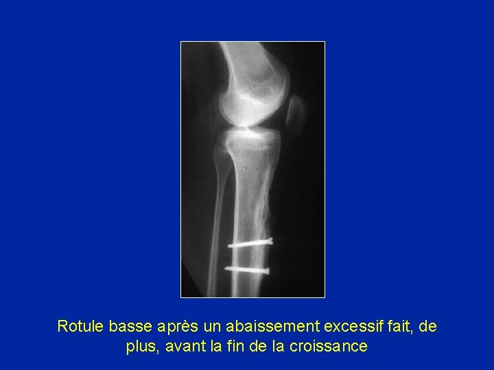 Rotule basse après un abaissement excessif fait, de plus, avant la fin de la