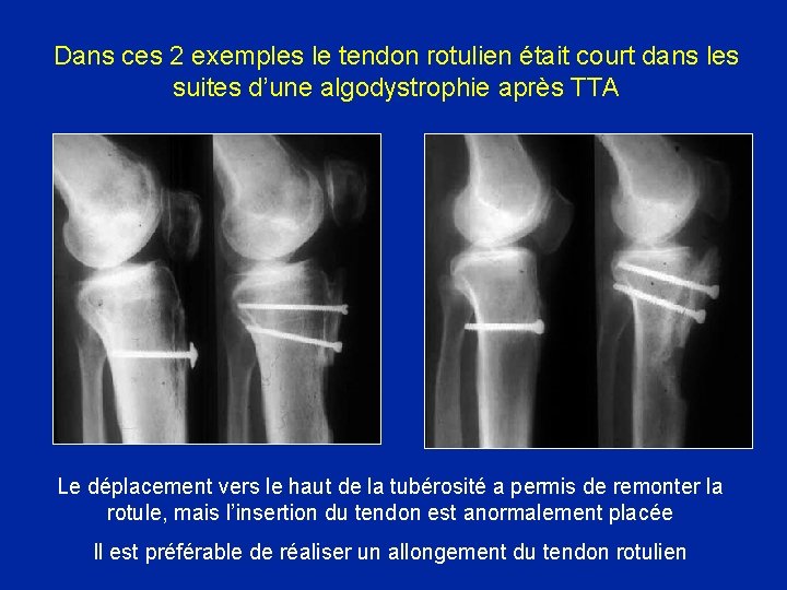 Dans ces 2 exemples le tendon rotulien était court dans les suites d’une algodystrophie