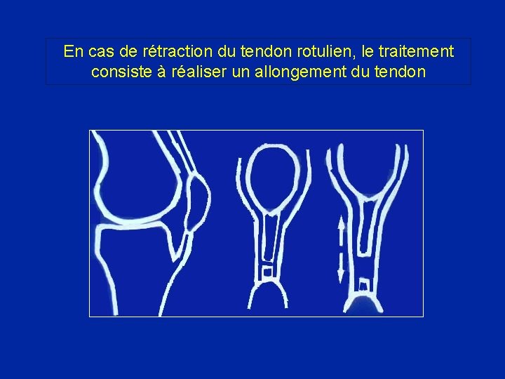 En cas de rétraction du tendon rotulien, le traitement consiste à réaliser un allongement