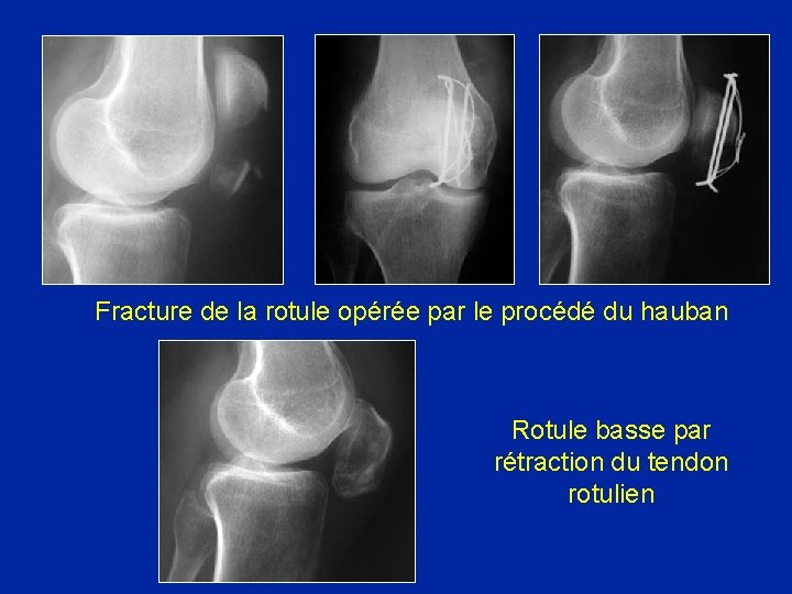 Fracture de la rotule opérée par le procédé du hauban Rotule basse par rétraction