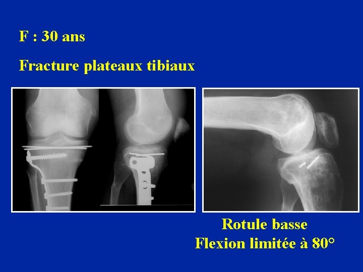 F : 30 ans Fracture plateaux tibiaux Rotule basse Flexion limitée à 80° 