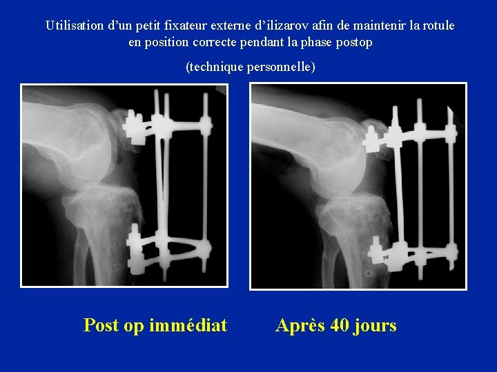 Utilisation d’un petit fixateur externe d’ilizarov afin de maintenir la rotule en position correcte