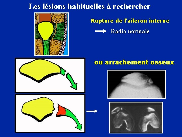 Les lésions habituelles à recher Rupture de l’aileron interne Radio normale ou arrachement osseux