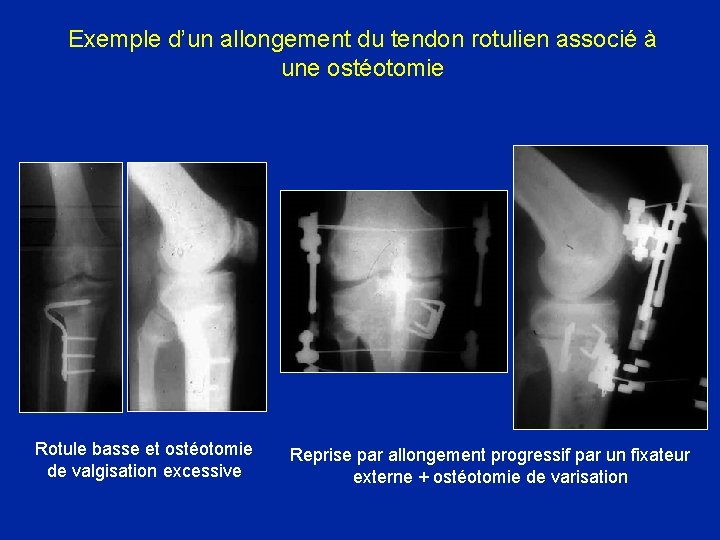 Exemple d’un allongement du tendon rotulien associé à une ostéotomie Rotule basse et ostéotomie