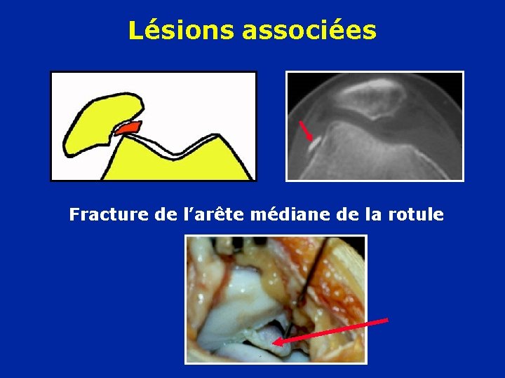 Lésions associées Fracture de l’arête médiane de la rotule 