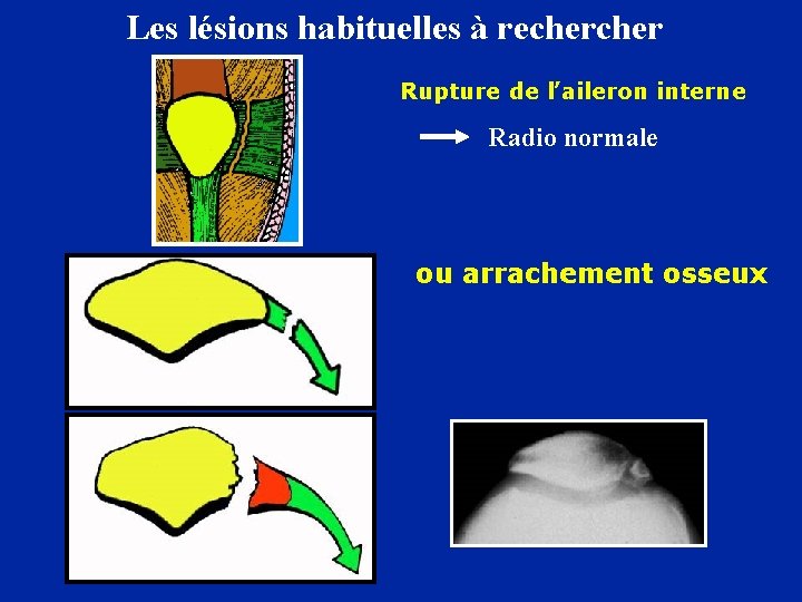 Les lésions habituelles à recher Rupture de l’aileron interne Radio normale ou arrachement osseux