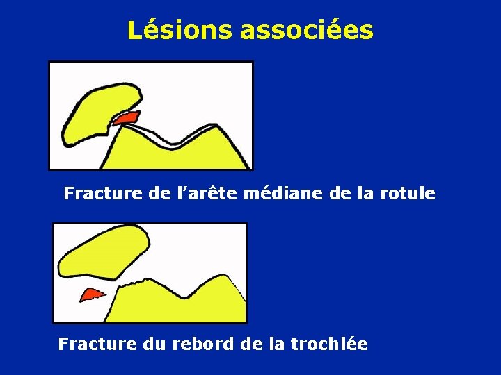 Lésions associées Fracture de l’arête médiane de la rotule Fracture du rebord de la