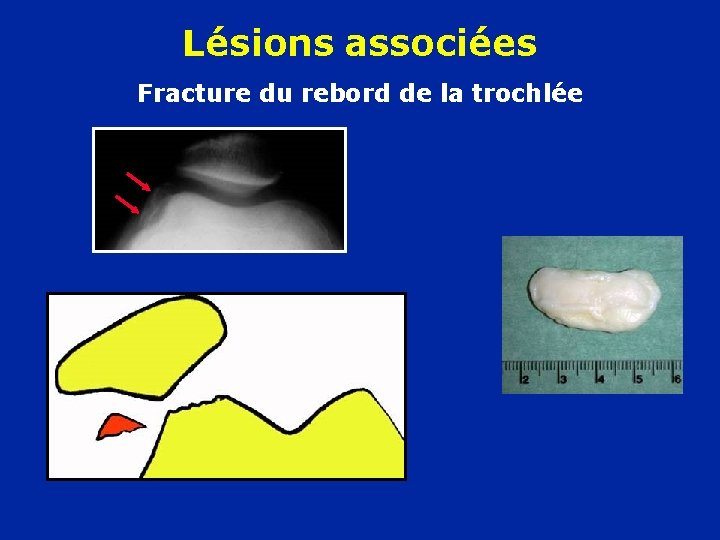 Lésions associées Fracture du rebord de la trochlée 