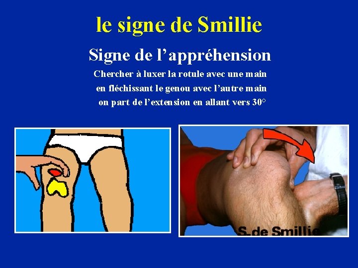 le signe de Smillie Signe de l’appréhension Chercher à luxer la rotule avec une