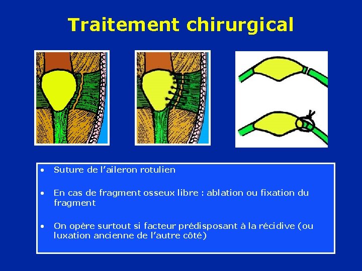 Traitement chirurgical • Suture de l’aileron rotulien • En cas de fragment osseux libre