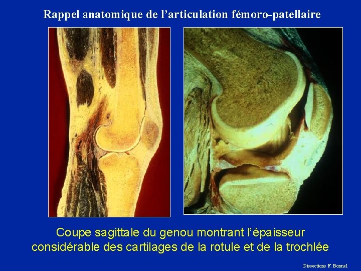 Rappel anatomique de l’articulation fémoro-patellaire Coupe sagittale du genou montrant l’épaisseur considérable des cartilages