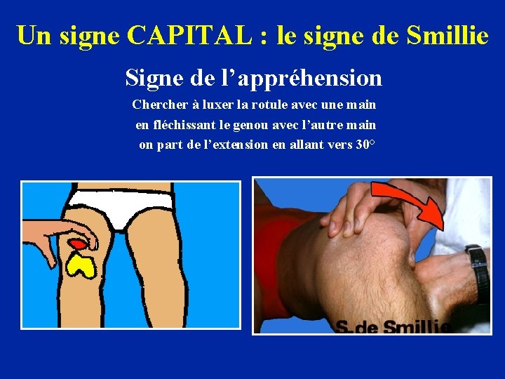 Un signe CAPITAL : le signe de Smillie Signe de l’appréhension Chercher à luxer