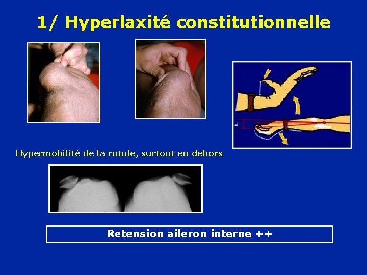 1/ Hyperlaxité constitutionnelle Hypermobilité de la rotule, surtout en dehors Retension aileron interne ++