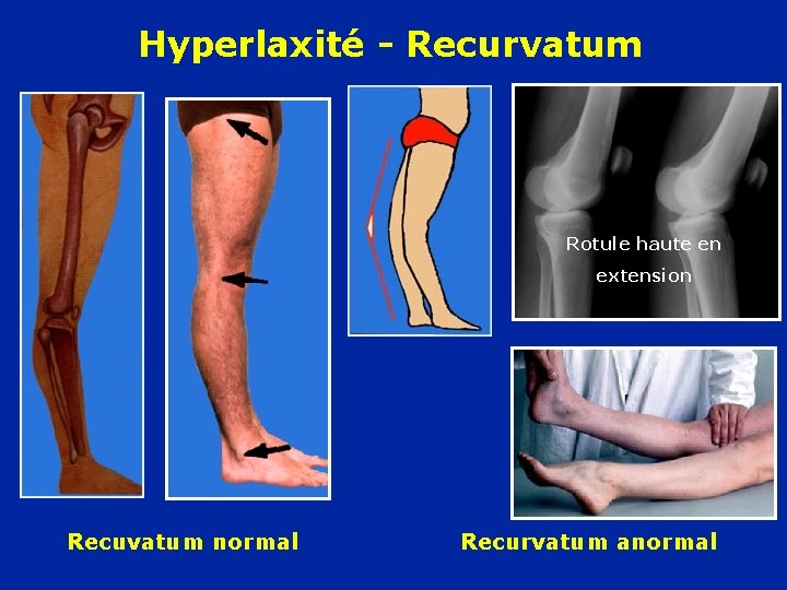 Hyperlaxité - Recurvatum Rotule haute en extension Recuvatum normal Recurvatum anormal 