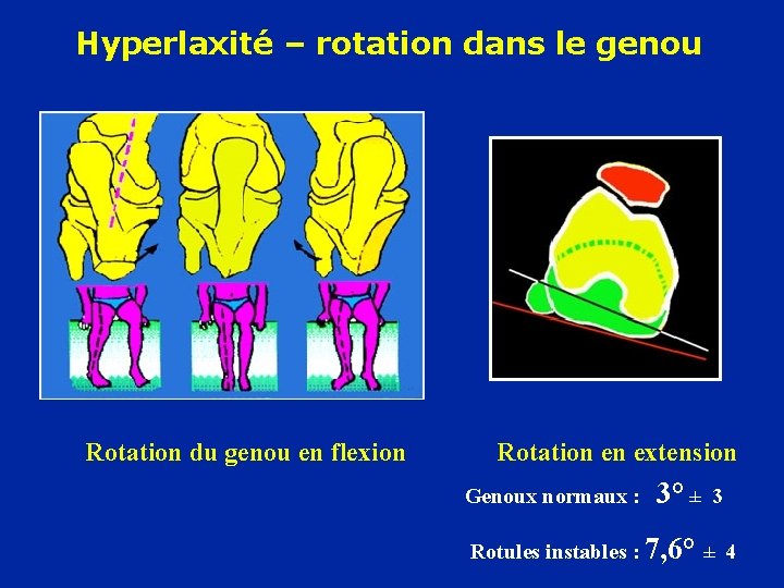 Hyperlaxité – rotation dans le genou Rotation du genou en flexion Rotation en extension