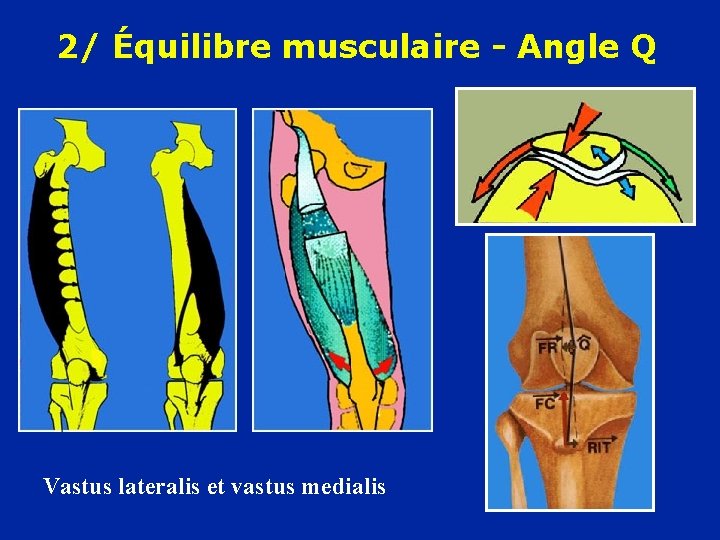 2/ Équilibre musculaire - Angle Q Vastus lateralis et vastus medialis 