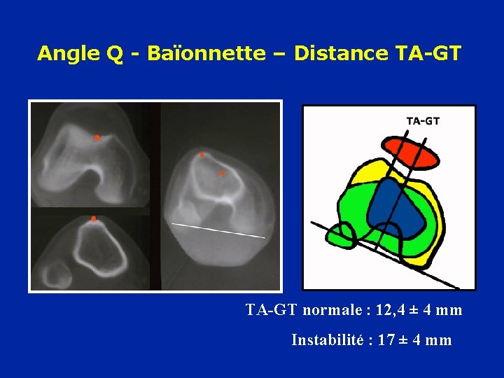 Angle Q - Baïonnette – Distance TA-GT normale : 12, 4 ± 4 mm