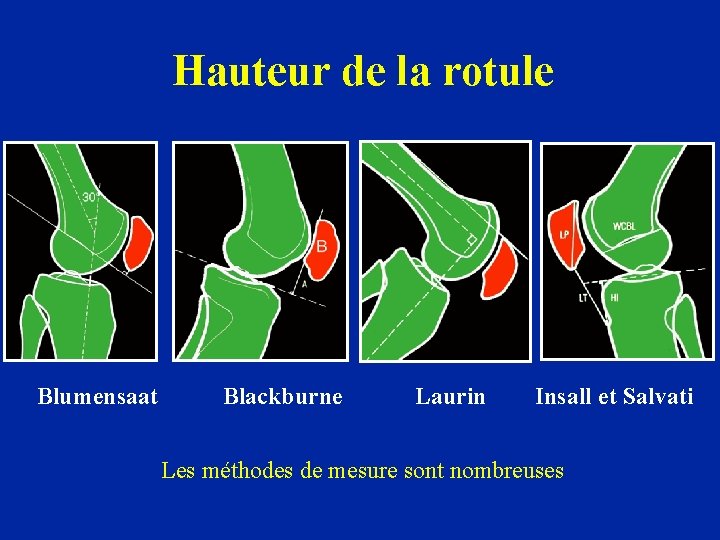 Hauteur de la rotule Blumensaat Blackburne Laurin Insall et Salvati Les méthodes de mesure