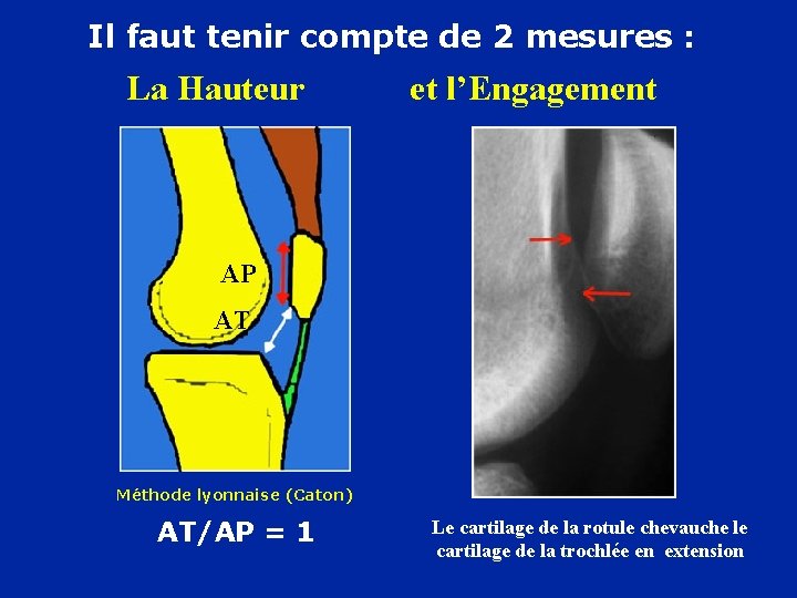 Il faut tenir compte de 2 mesures : La Hauteur et l’Engagement AP AT